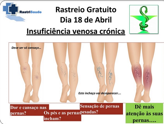 Farmácia Apolinário – Rastreio gratuito sobre “Insuficiência Venosa Crónica”